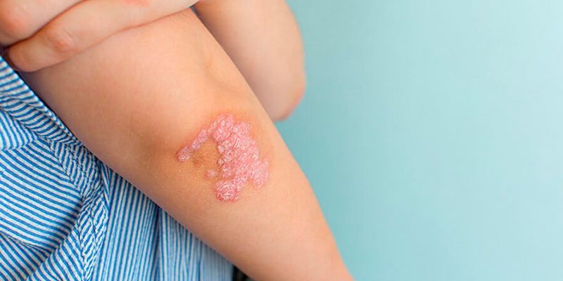 Espondiloartropatias - Dra. Mónica Sarmiento