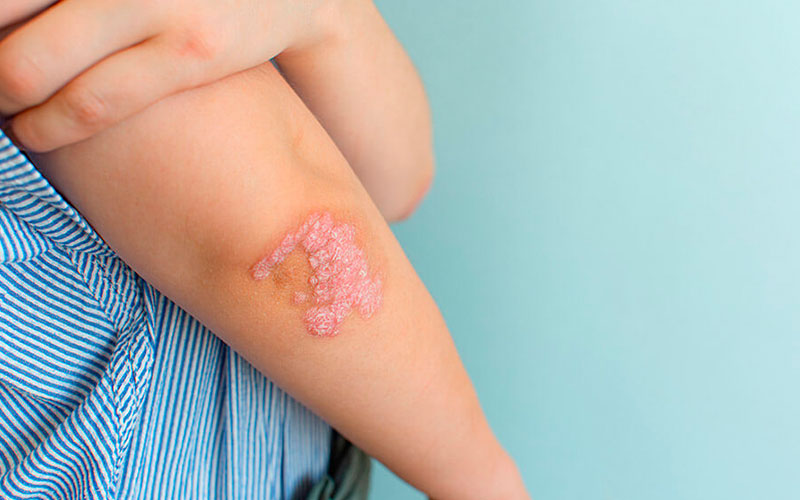 Espondiloartropatias - Dra. Mónica Sarmiento