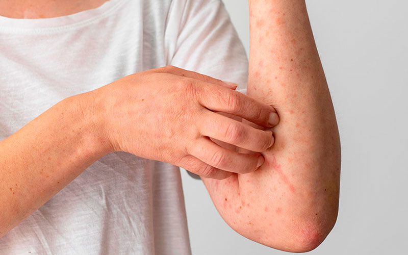 ANA Positivos: ¿Significa Esto que Tengo Lupus? - Dra. Mónica Sarmiento
